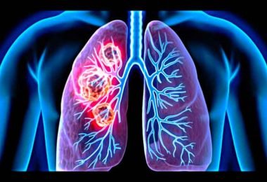 Lung cancer - causes, symptoms, diagnosis, treatment, pathology